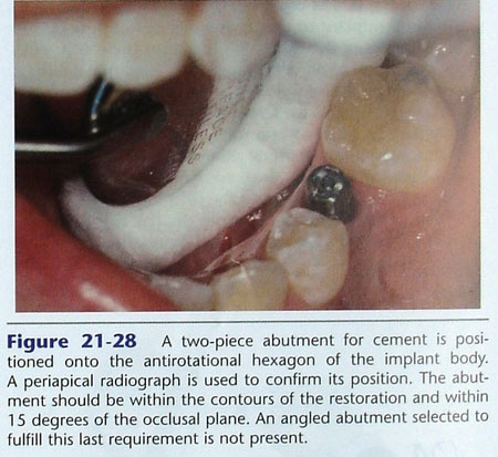 phuc-hinh-implant-2