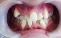 Mối liên quan giữa lệch lạc khớp cắn và dịch vụ Niềng răng?