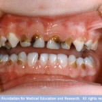 Nguyên nhân gây sâu răng? 