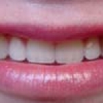 Răng nanh ngầm - Có nên nhổ bỏ?