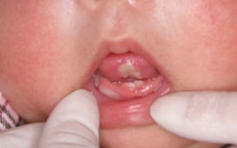 Gồng mình - nghiến răng trẻ có thể bị thiếu canxi ?