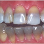 Răng nhiễm sắc tố vàng, nâu hay đen. Cách chữa trị. 