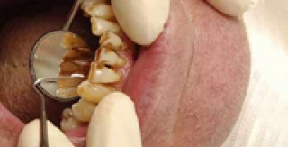 Nha chu - bệnh nguy hiểm trong nha khoa