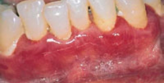 Bệnh nướu do yếu tố toàn thân