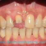 Răng sứ Ivoclar vivadent 11