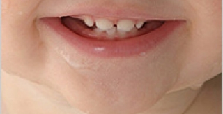 Nên chăm sóc răng cho trẻ từ sớm