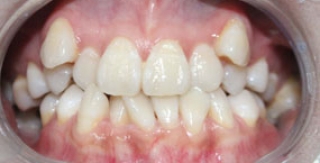 Chỉnh hình răng thẩm mỹ điều trị răng khểnh với mắc cài kim loại
