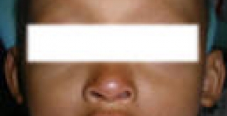 Loạn sản ngoại bì ở trẻ em 