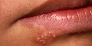 Một số bệnh răng miệng do siêu vi (Virus) 
