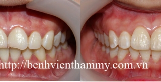 Trám răng Composite-Tetric-N-Ceram -Nano-Ivoclar Vivadent-Thụy sỹ