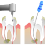 Chữa tủy răng, phương pháp nội nha là gì? (Enodontics, root canal treatment) 