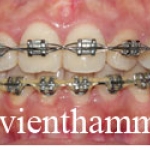 Chỉnh hình răng thẩm mỹ điều trị răng thưa và hô với mắc cài kim loại