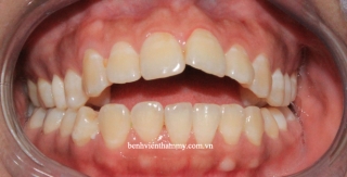 Nụ cười hoàn hảo sau khi điều trị răng hô