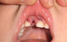 Xử trí khi răng trẻ bị bật khỏi ổ răng