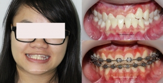 Chỉnh hình răng thẩm mỹ điều trị không nhổ răng