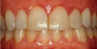 Viêm nướu do mảng bám vi khuẩn