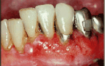 Các khối u ác tính vùng hàm mặt (Malignant tumor, oral cancer) 