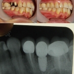 Phục hình thẩm mỹ răng sứ và implant