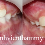 Chỉnh hình răng can thiệp sớm cắn ngược răng trước 2