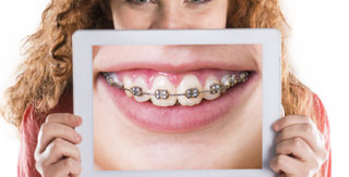 Chỉnh răng thẩm mỹ răng hô kèm cắn sâu