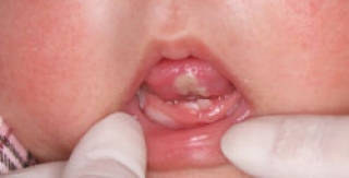 Răng sơ sinh 