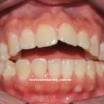 Nụ cười hoàn hảo sau khi điều trị răng hô