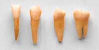 Những nguyên nhân dẫn đến việc cần nhổ răng