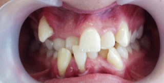 Răng lệch lạc, chữa thế nào?