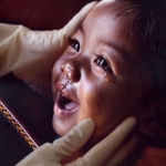 Nghệ An: Phẫu thuật nhân đạo cho trẻ em dị tật vùng mặt