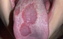 Viêm lưỡi bản đồ 