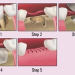 Nhổ răng bảo tồn xương ổ răng. 