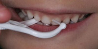 Phương pháp sử dụng bộ giữ chỉ nha khoa (dental floss holder)