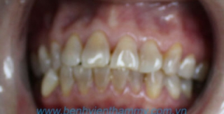 Răng sứ Emax Zircad - Ivoclar Vivadent 6