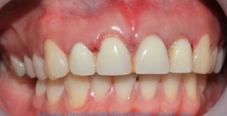 Răng sứ thẩm mỹ 4 răng Emax ZirCad