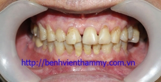Trám răng Composite-Tetric-N-Ceram A3-DentinA3,5-Ivoclar Vivadent