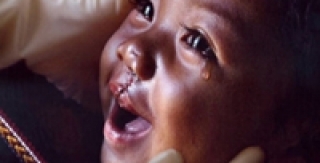 Nghệ An: Phẫu thuật nhân đạo cho trẻ em dị tật vùng mặt