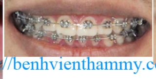 Chỉnh hình răng thẩm mỹ điều trị răng chen chúc với mắc cài kim loại