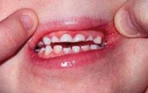 Tật nghiến răng ở trẻ em – Phần 1 