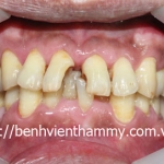 Trám răng Composite-Tetric-N-Ceram A3-C2-DentinA3,5-C1-Ivoclar