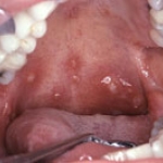 Biểu hiện vùng miệng của nhiễm HIV – AIDS