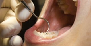 Phương pháp mới điều trị tụt Lợi/Nướu 