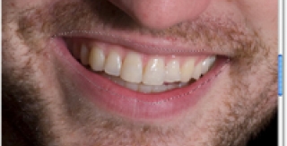Hạn chế lấy tủy răng trong điều trị nha khoa 
