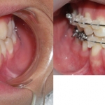 Chỉnh hình răng thẩm mỹ điều trị răng móm với mắc cài sứ thẩm mỹ