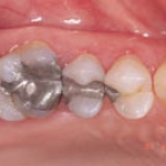 Hợp chất trám răng chứa thủy ngân an toàn cho sức khỏe