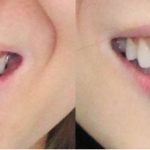 Chỉnh hình răng thẩm mỹ điều trị cười hở nướu và hàm lệch với mắc cài kim loại