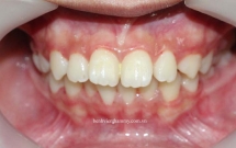 Chỉnh răng hô ở trẻ em