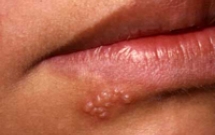 Một số bệnh răng miệng do siêu vi (Virus) 