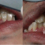 Chỉnh hình răng thẩm mỹ điều trị răng móm – chen chúc - cắn chéo