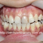 Răng sứ Ivoclar vivadent 15