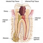 Những răng nào cần phải chữa nội nha? 